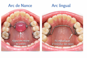 Schéma de l'arc de Nance et de l'arc lingual