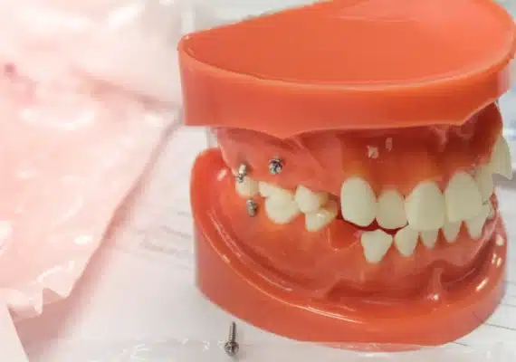 Mini-implant (minivis)