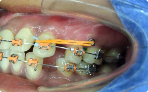 Mini-implant relié à l'appareil par un élastique
