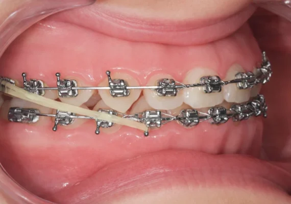 TIM 2 et TIM 3 (Tractions Intermaxillaires)
