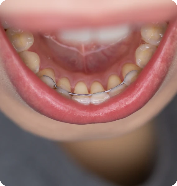 Fil de contention collé derrière les dents