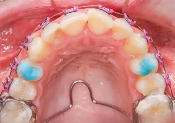 Quad Helix