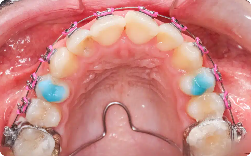 Quad Helix